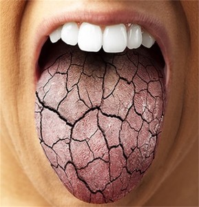 dry-mouth